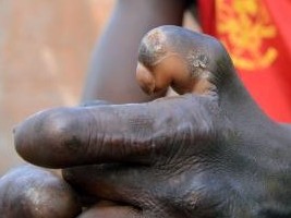 Haiti - Health : 50 new cases of leprosy in the country