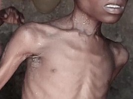 Haiti - Crisis : More than 18% of the population at risk of very high malnutrition