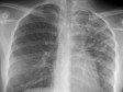 Haiti - Health : The country has the highest rate of tuberculosis in the Americas